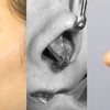 鼻中隔延長術：延長移植軟骨を鼻翼軟骨で隠すか、鼻翼軟骨を越えて突出させるかの画像