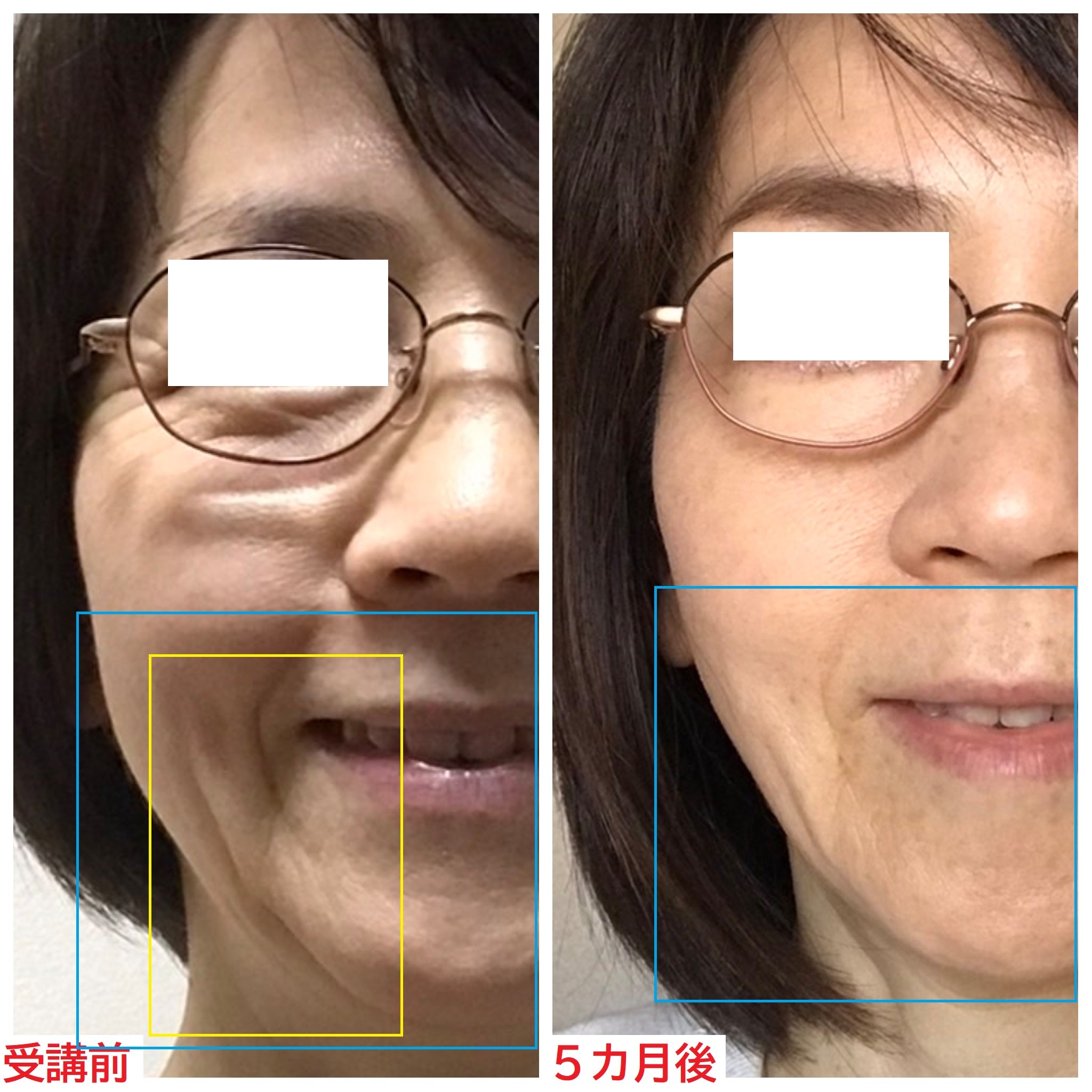 大人女子は口横で変わる | 美容整形不要!シワとたるみを改善 大人女子は口横で変わる | 美容整形不要!シワとたるみを改善