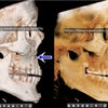 セットバック(突出口)手術後、口がすぼまって長い顔に - 中顔面部陥没ボリューム成形手術の画像