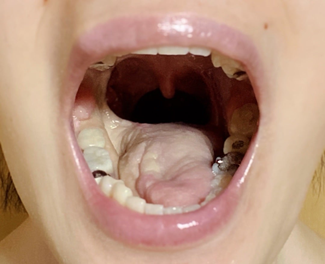 舌がんの特徴って？歯科衛生士がメインテナンス時に診るべきポイント│歯科スタッフ向けメディアdStyle（ディースタイル）