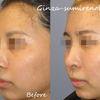 鼻中隔延長部全摘：鼻中隔補強術とストラット法による鼻尖扁平化とアップノーズの回避の画像