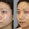 鼻骨々切り幅寄せ術＋鼻尖縮小術（SAD法）の効果について：術後6ヵ月　の画像