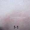 フラクショナル.切除縫合.ピーリングなど治らない・水疱瘡の跡.傷跡修正.手術跡(凹みクレーター)の画像