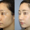 初回手術：鼻骨々切り幅寄せ術＋上下鼻軟骨形成術＋細片耳珠軟骨移植術　術後６ヵ月の画像