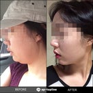 顔脂肪吸引及び脂肪移植も、韓国狎鷗亭トップラインがイチオシ！の記事より