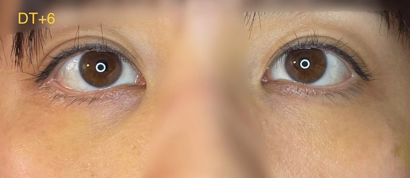 ウリ美容外科にて目の下の脂肪再配置（ダウンタイム）