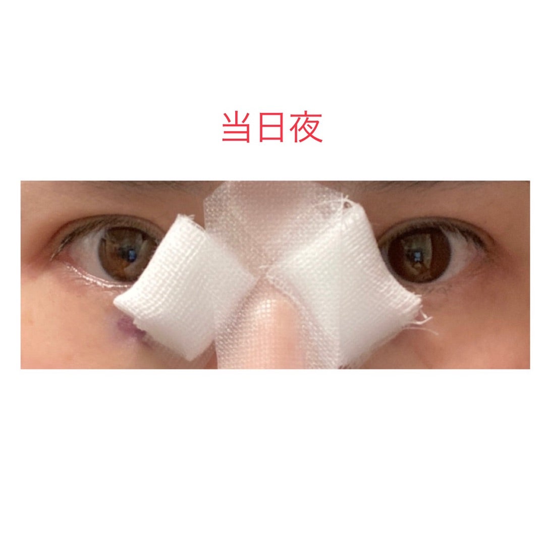 目頭切開手術〜１日目、ガーゼを外す〜の記事画像