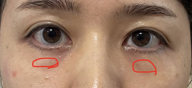 ウリ美容外科にて目の下の脂肪再配置（手術前）