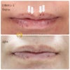 唇のシミ治療の画像