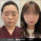 顔脂肪吸引及び脂肪移植も、韓国狎鷗亭トップラインがイチオシ！の記事より