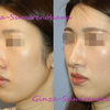 延長部減量術および鼻骨修正術：鼻中隔軟骨による鼻中隔延長術＋わし鼻形成術に対する修正の画像