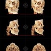 【手術記録38】輪郭整形顎先前進術の症例：Uライン VS Vラインの画像