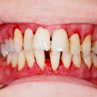 一般的に歯周病は治せない！