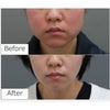 頬と顎のベイザー脂肪吸引・30代女性・BMI 23の画像
