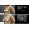 エクソソーム豊胸・20代女性・BMI 20・超音波検査の画像