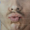 唇・お口周りのヒアルロン酸の画像