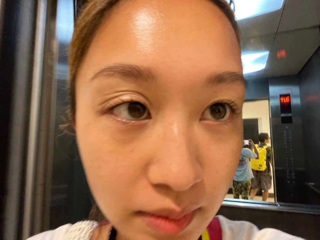 朝起き たら 目 が 腫れ てる