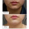 割れ顎の脂肪注入・CRF・10代女性・BMI 19の画像