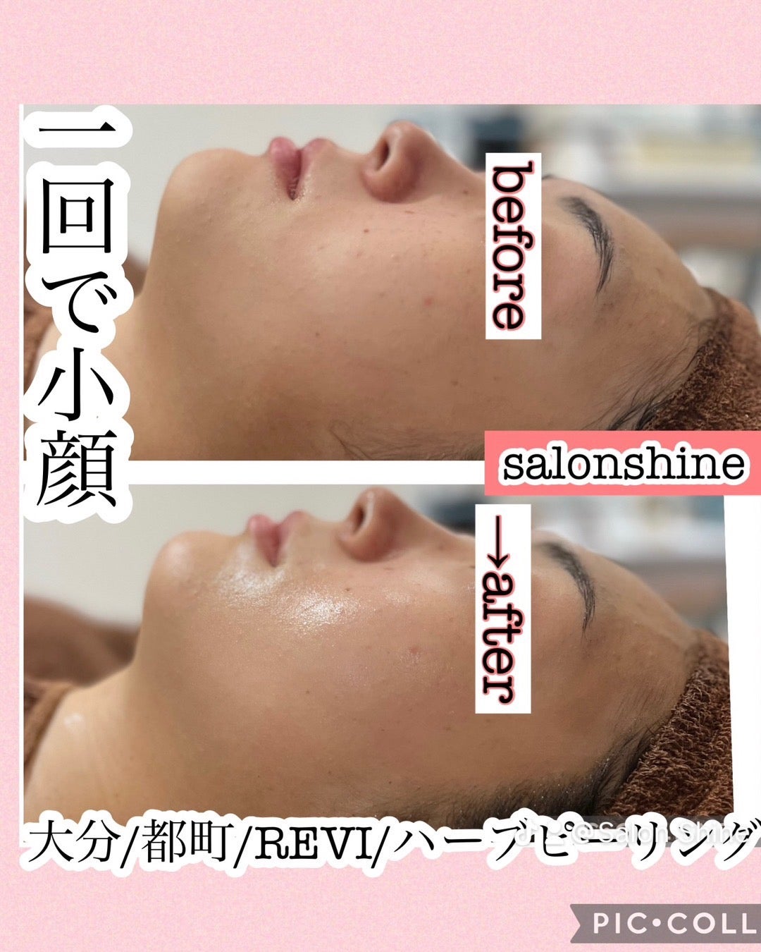 REVI 陶肌ハーブピーリング - 化粧水/ローション