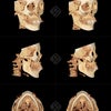 【手術記録40】45度頬骨縮小手術の症例：微細かつ確実な変化の画像
