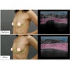 エクソソーム豊胸・超音波検査・30代女性・BMI 19の画像