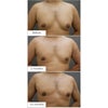 女性化乳房・ベイザー脂肪吸引・拘縮の経過・20代男性・BMI 23の画像