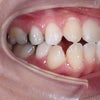 ２２歳女性　主訴は凸凹　小臼歯３本と親知らず２本抜歯での矯正治療が終了しました。の画像