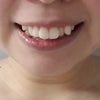 犬歯と八重歯の違いの画像