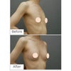 エクソソーム豊胸・30代女性・BMI 17の画像