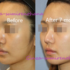 鼻中隔延長術修正：延長軟骨減量術および鼻孔縁形成術　術後7ヶ月の画像