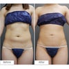 腹部のベイザー脂肪吸引・20代女性・BMI 22の画像