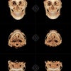 【手術記録45】頬骨縮小、実際の手術前後のCT:バッカルファット除去・頬と顎下の脂肪吸引の画像
