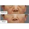 目の下のたるみ治療・脱脂＋お顔の脂肪注入・50代女性・BMI 19の画像