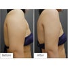 二の腕・肩のベイザー脂肪吸引・30代女性・BMI 27の画像