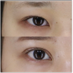 １９歳女性・平行二重希望　『眼瞼下垂＋たるみ取り併用二重全切開＋目頭切開』６ヶ月後