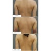 二の腕・肩のベイザー脂肪吸引・ダウンタイム・20代女性・BMI 18の画像