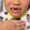 6歳の息子　6本目の歯が抜けるの画像