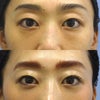 拡大経結膜下瞼板形成手術による目の下のクマ取りの画像