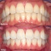 セルフホワイトニング新規開拓＆最近の歯並びの画像