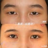 切開法重瞼術～mix型ないし狭めの平行型二重～の画像