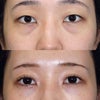 20代女性の上瞼と下瞼の形成手術の画像