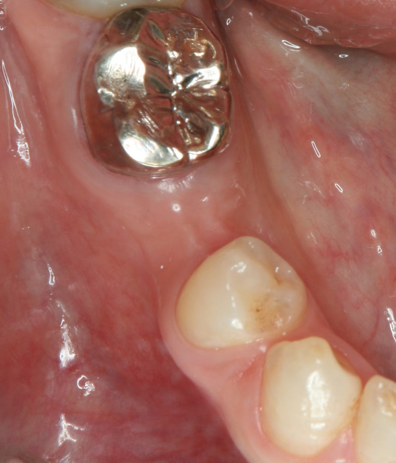 第2小臼歯の先天性歯牙欠如