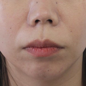 33歳　女性　主訴は上顎前突　上顎小臼歯２本抜歯による治療が終了しました。の画像