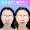 【年末にもおすすめ】上向き鼻を一度で解消！須田先生の複合鼻施術で顔のバランスを整えました【小鼻】の画像