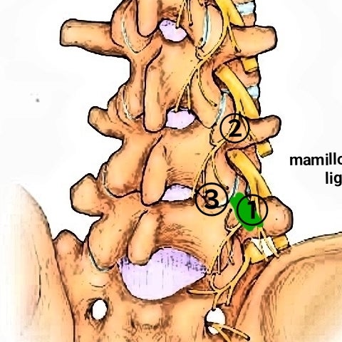 脊髄神経後枝内側枝　椎間関節炎