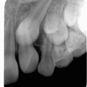 初診時年齢9歳　女子　左上犬歯の埋伏が主訴　非抜歯治療から途中で抜歯治療へ切り替えました。の画像