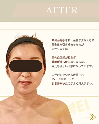 【Before after】頬骨管理・頬のたるみ管理を受けられたお客様の記事より