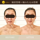 【Before after】頬骨管理・頬のたるみ管理を受けられたお客様の記事より