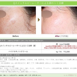 【症例紹介】Qスイッチルビーレーザによる顔のシミ治療
