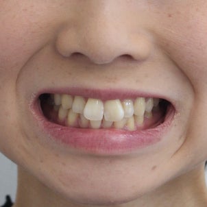 ２５歳　女性　上顎前突が主訴　小臼歯４本抜歯、途中出産を経ての治療が終了の画像